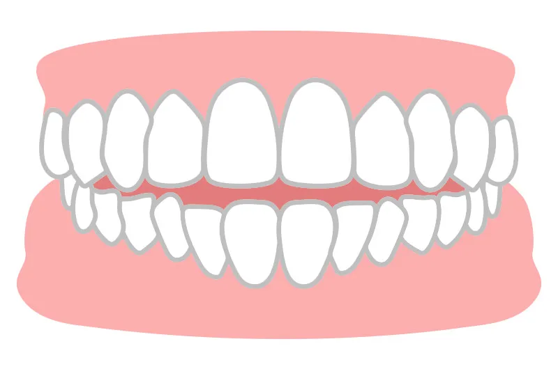 開咬（前歯が閉じない）