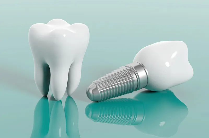 歯を失った部位への治療：噛み合わせの調和を整え、口全体の健康を再構築する