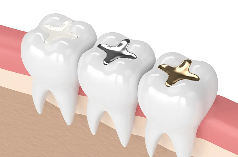 歯の機能を復元する補綴治療