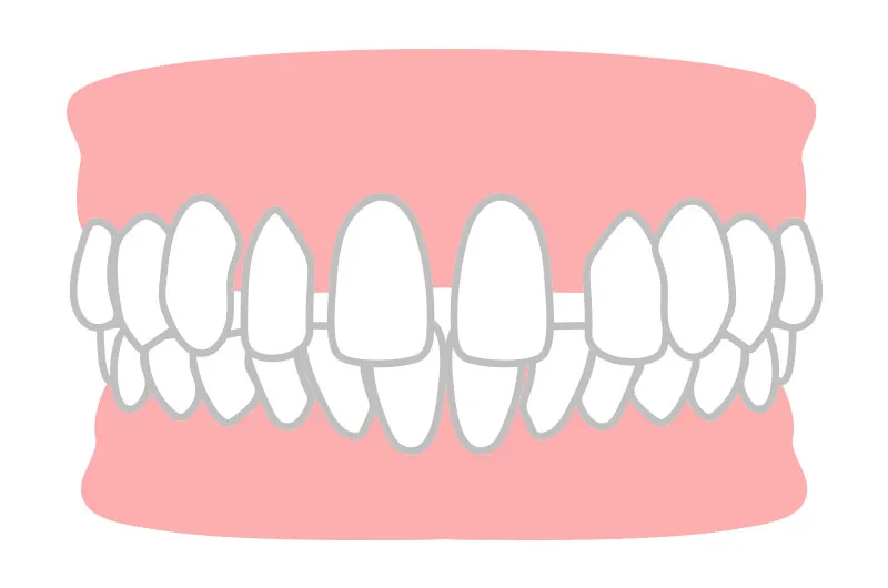 空隙歯列（すきっ歯）