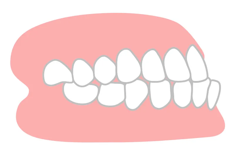 反対咬合（受け口）