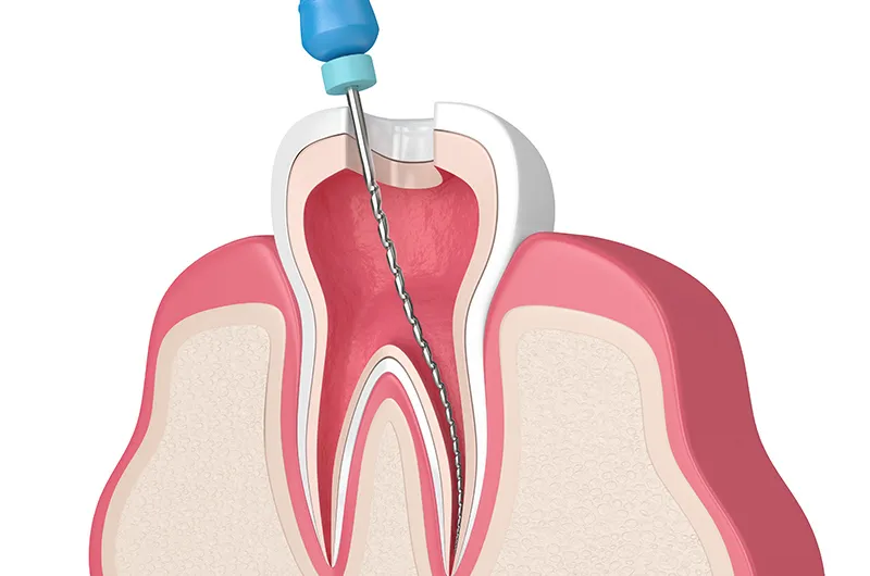 精密根管治療とは