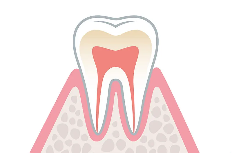 歯肉炎（初期）