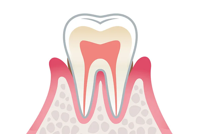 軽度歯周炎
