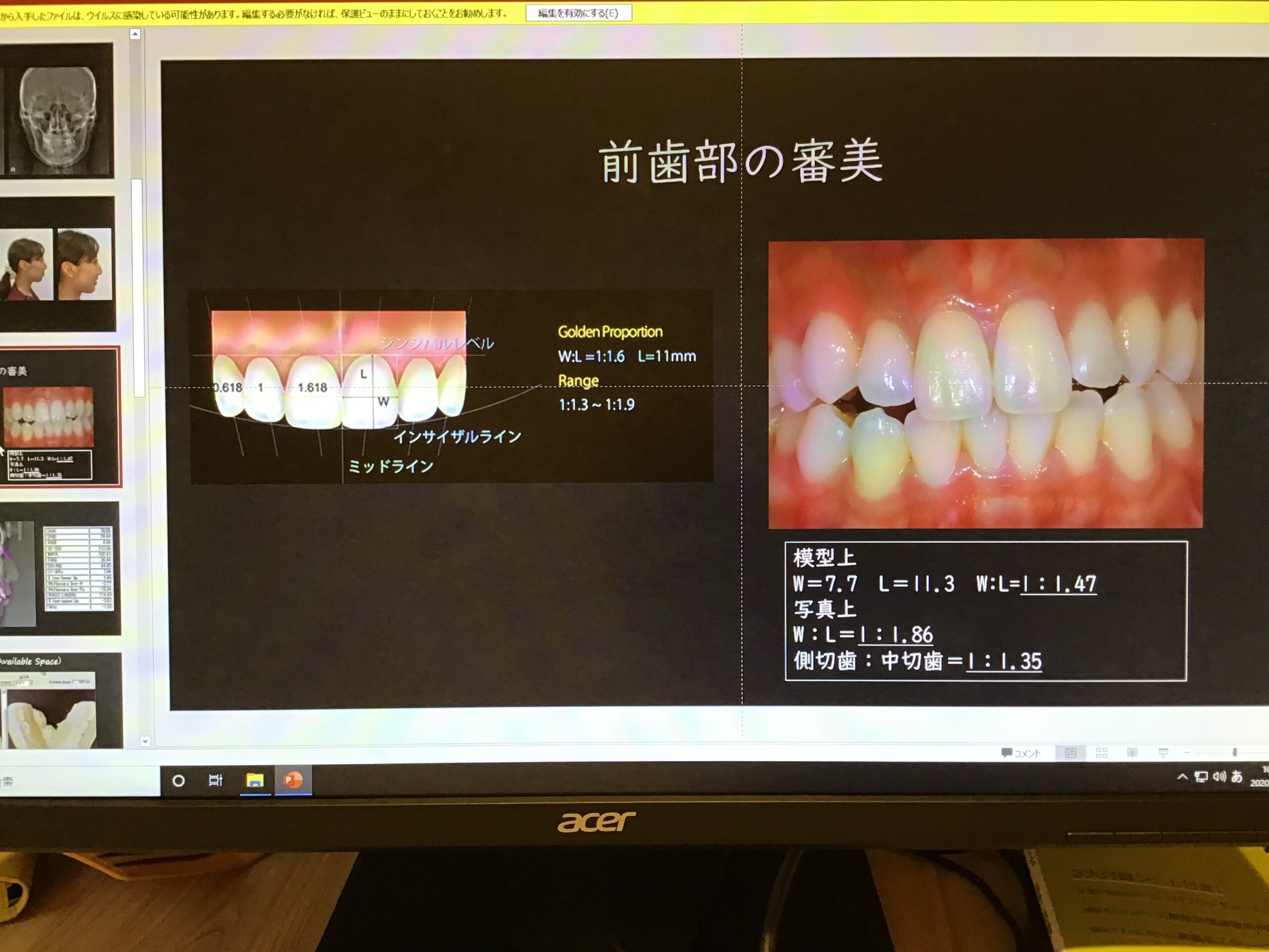 私の矯正事情☺